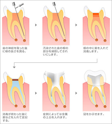 重度の虫歯は根管治療で治します