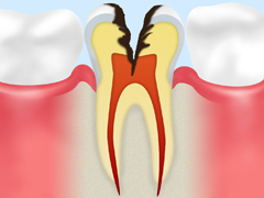 C3：神経まで達した虫歯