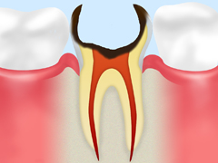 C4：歯根まで達した虫歯