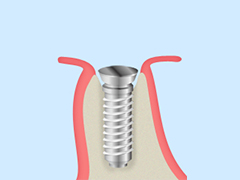 インプラント埋入