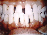 歯周病によって悪化した歯並びの審美治療