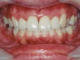 残根状態の歯の修復