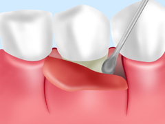 歯周外科処置