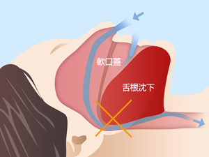 スリープスプリントによる治療前