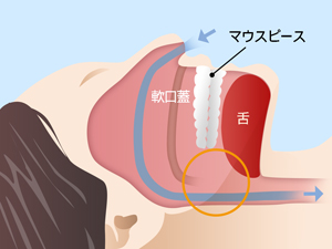 スリープスプリントによる治療後